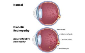 dia_retinaopathy_600x375-480x300