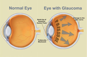 glaucoma