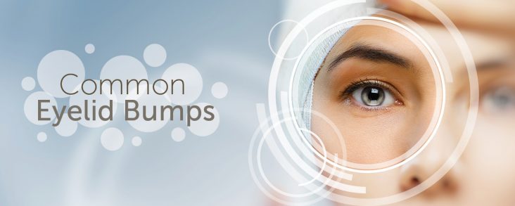 Common Eyelid Bumps