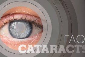 FAQ Cataracts